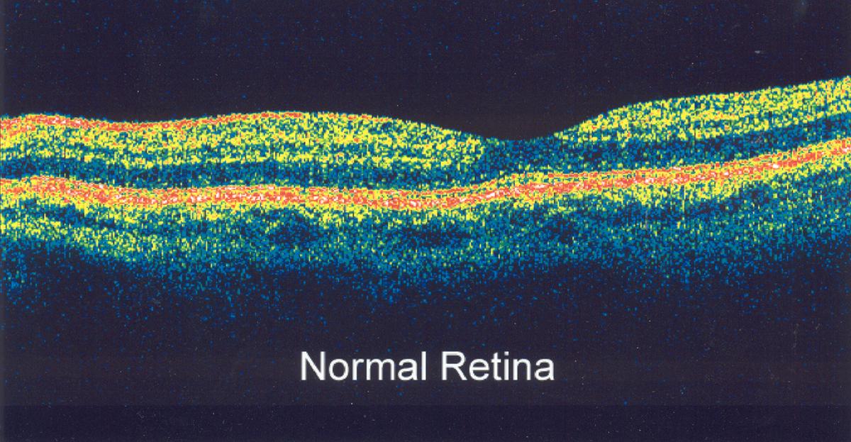 retinal image